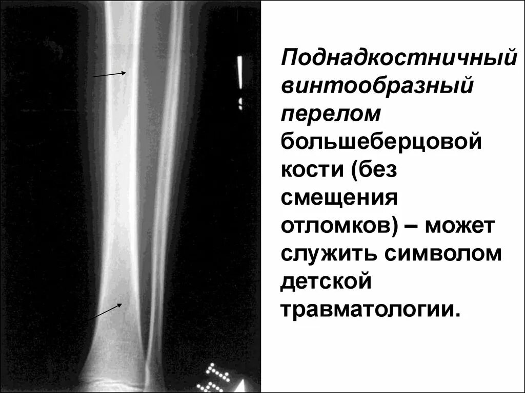 Поднадкостничная гематома большеберцовой кости фото Картинки ПЕРЕЛОМ ПОДНАДКОСТНИЧНЫЙ ЛУЧЕВОЙ КОСТИ