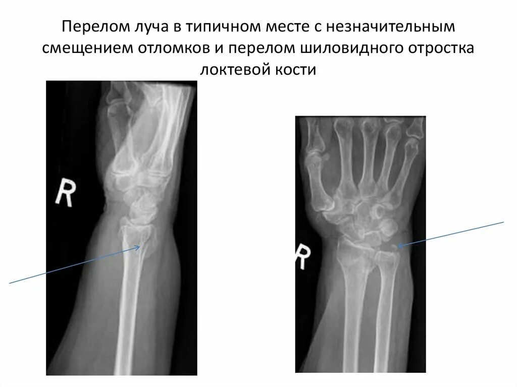 Поднадкостничный перелом лучевой кости фото Закрытый перелом луча в типичном