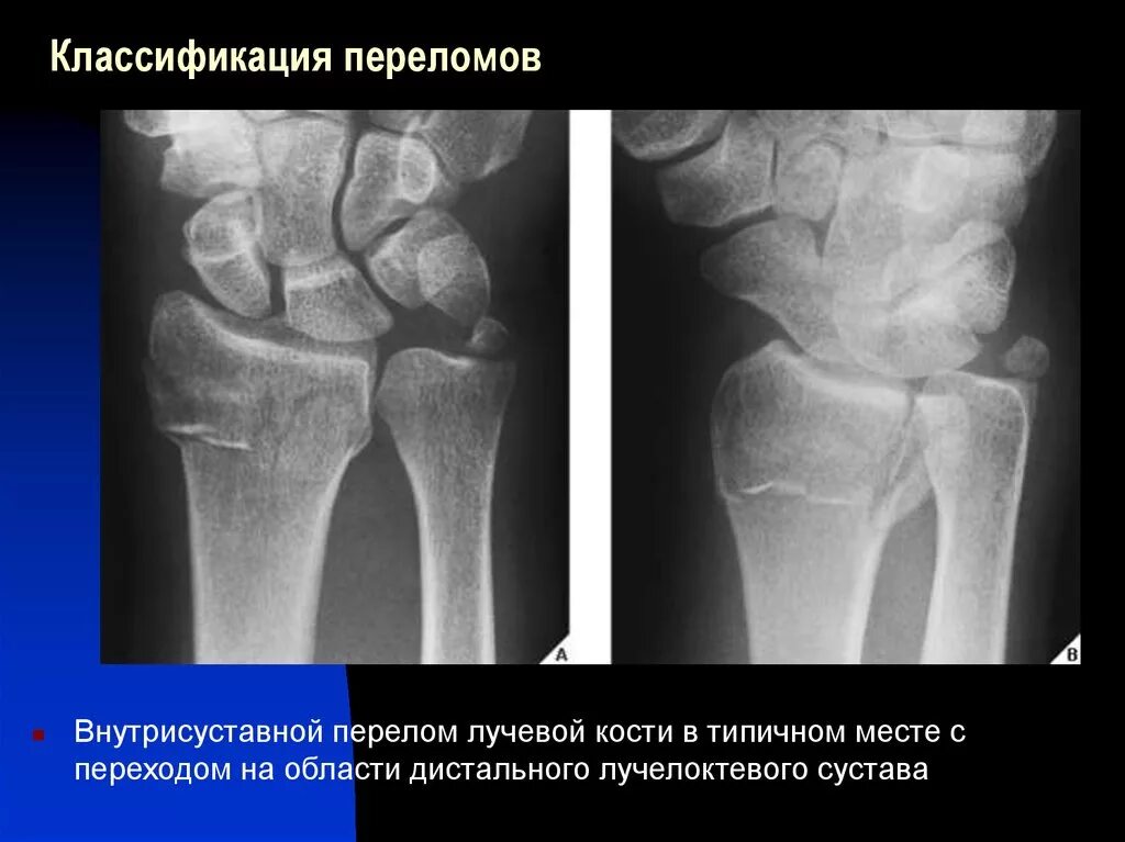 Поднадкостничный перелом лучевой кости фото Клинические рекомендации перелом дистального конца лучевой кости