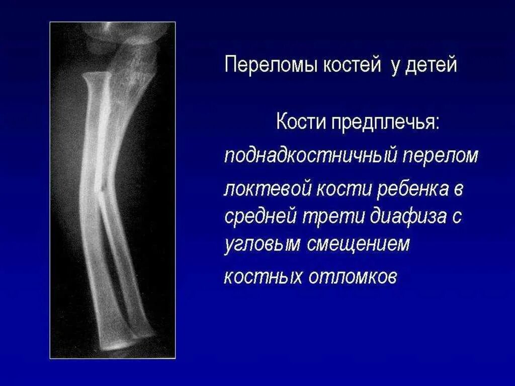 Перелом диафиза лучевой кости по утвержденным ответы: найдено 82 картинок