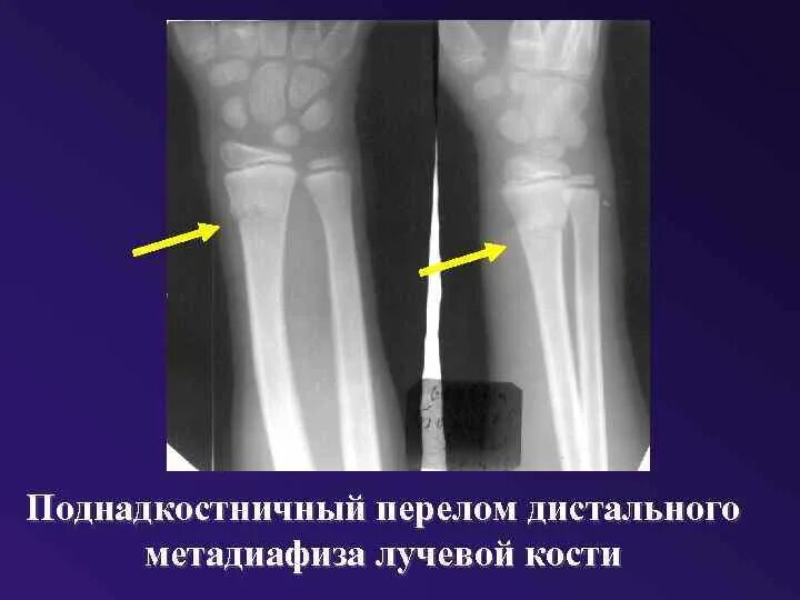 Поднадкостничный перелом лучевой кости фото Картинки ДИСТАЛЬНЫЙ ПЕРЕЛОМ ЛУЧЕВОЙ