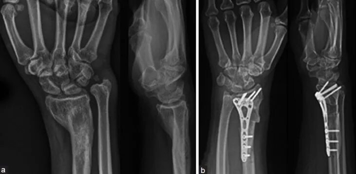 Поднадкостничный перелом лучевой кости фото X-ray anteroposterior and lateral views (a) Malunited distal radius... Download 