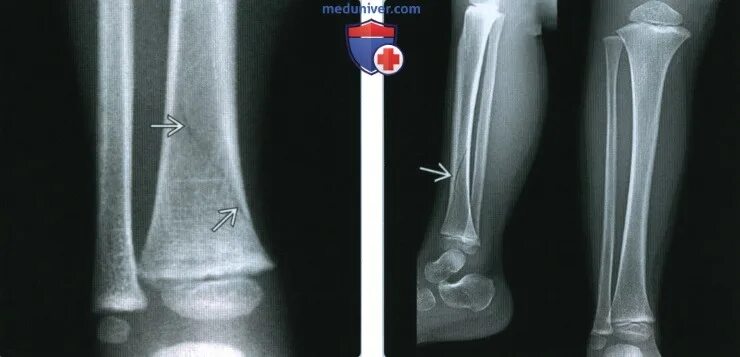 Поднадкостничный перелом лучевой кости фото Рентгенограмма при переломе у ребенка начинающего ходить