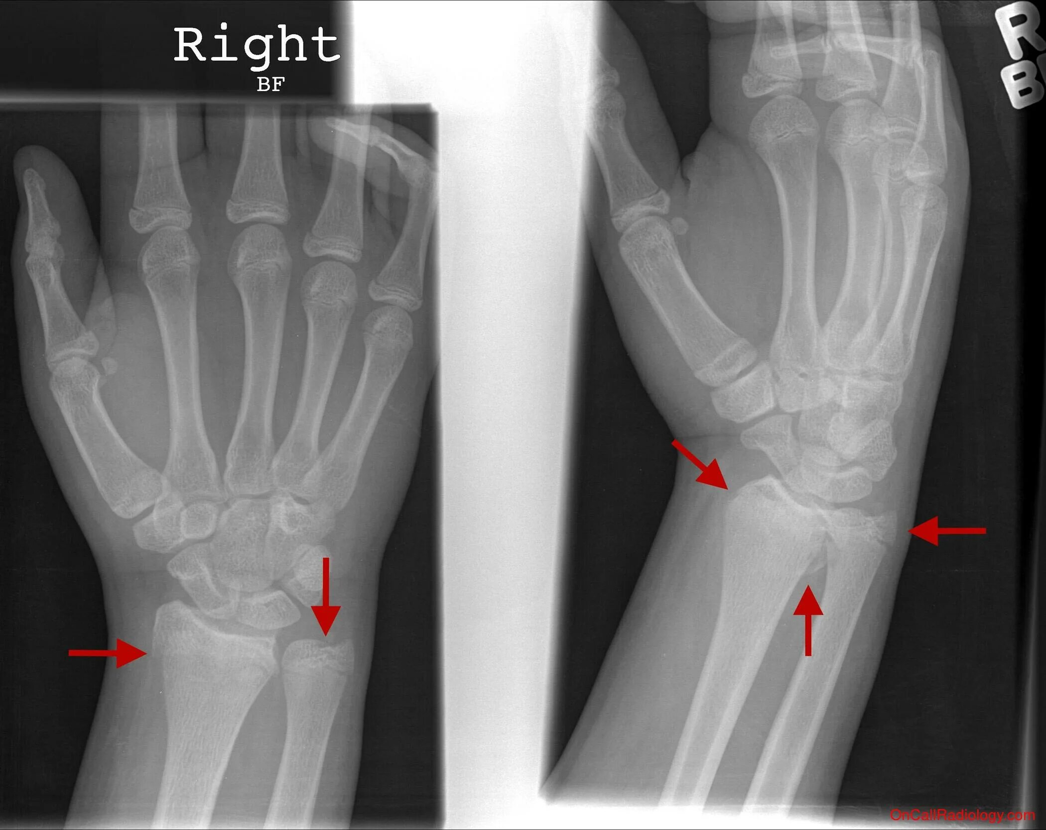 Поднадкостничный перелом лучевой кости фото Emergency Radiology - Trauma (Distal radius and ulnar head fracture - Plain film