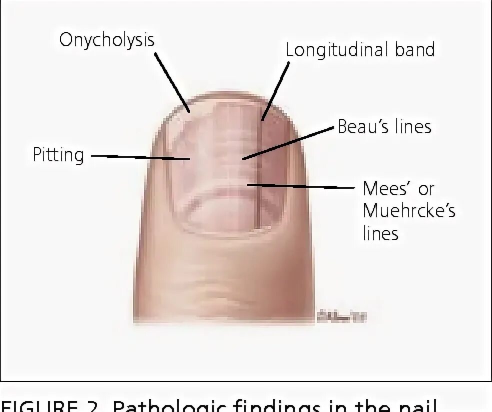 Подногтевая меланома фото начальной стадии как выглядит Figure 2 from Lateral nail fold Distal edge of nail plate Anterior ligament Lunu