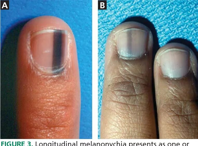 Подногтевая меланома симптомы фото Figure 3 from Evaluation of nail lines: Color and shape hold clues Semantic Scho