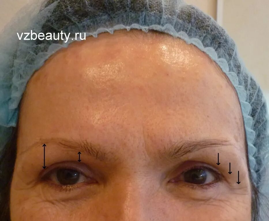 Поднять брови ботоксом фото Лифтинг (поднятие) бровей с помощью "ботокса" - vzbeauty.ru