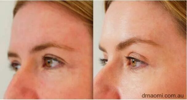 Поднять брови ботоксом фото Eyebrow botox lift Botox brow lift, Brow lift, Botox