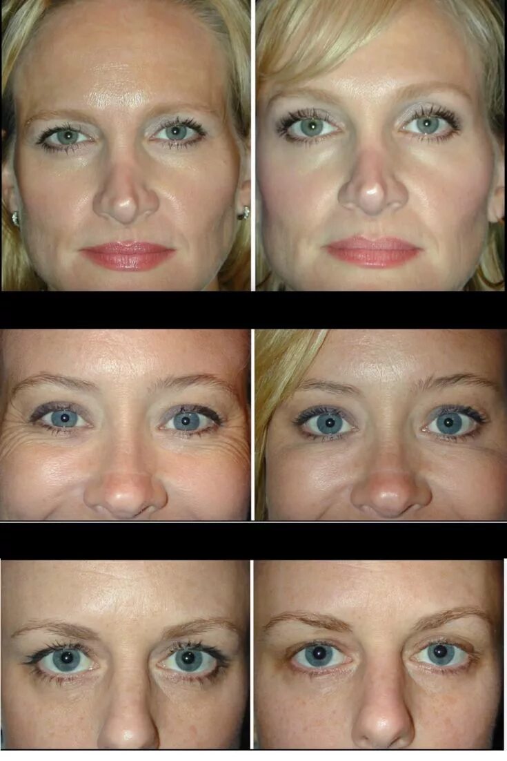 Поднять брови ботоксом фото Botox for an eyebrow lift? You would be amazed at the results, and how this is w