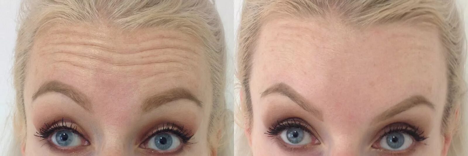 Поднять брови фото до и после Bump Above Eyebrow After Botox - Release Date Price Reviews