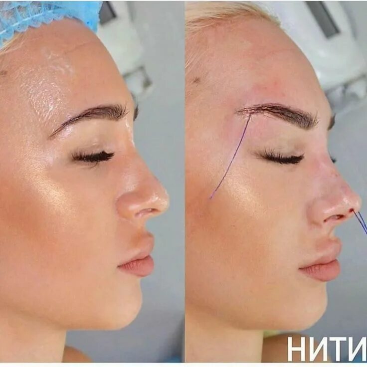 Поднять брови нитями фото Achieve the 'Fox Eyes' Look with PDO Threading and Botox