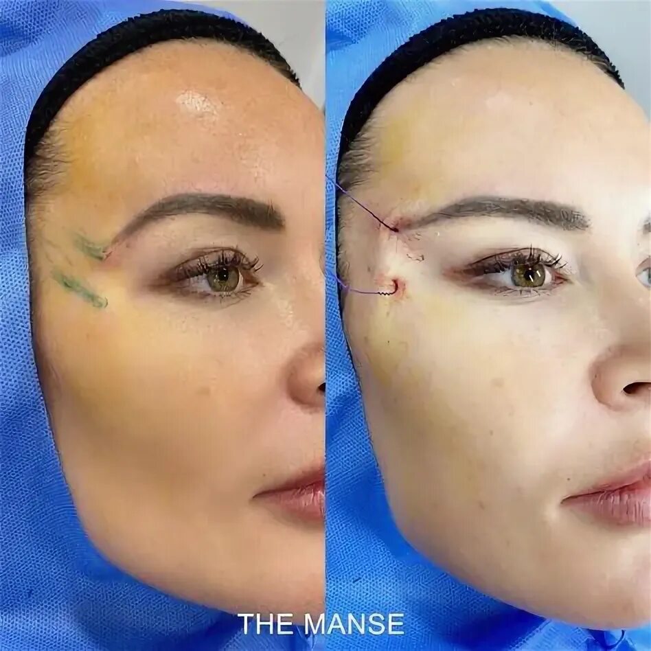 Поднять брови нитями фото до и после Enhance Your Look with Fox Eye Lift Surgery