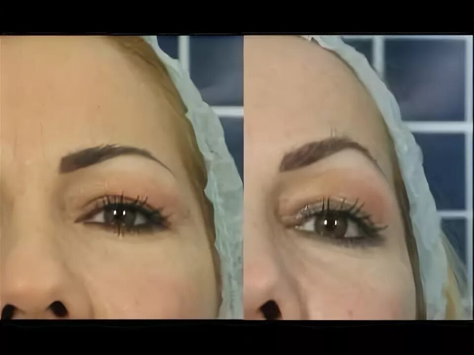 Поднять брови нитями фото до и после Eyebrow Lift Dr Ciro Accardo - подтяжка бровей Доктор Чиро Аккардо - YouTube