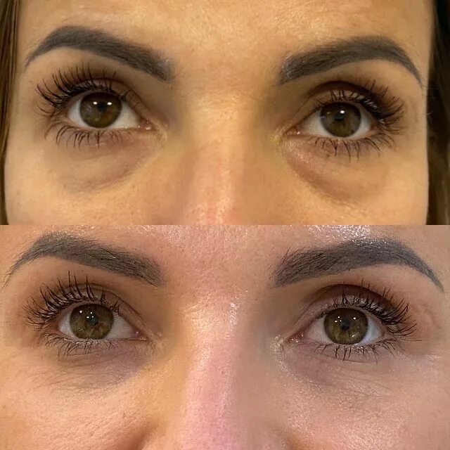 Eyebrow botox lift