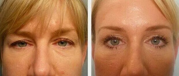 Поднять веки ботоксом фото Eyebrow botox lift