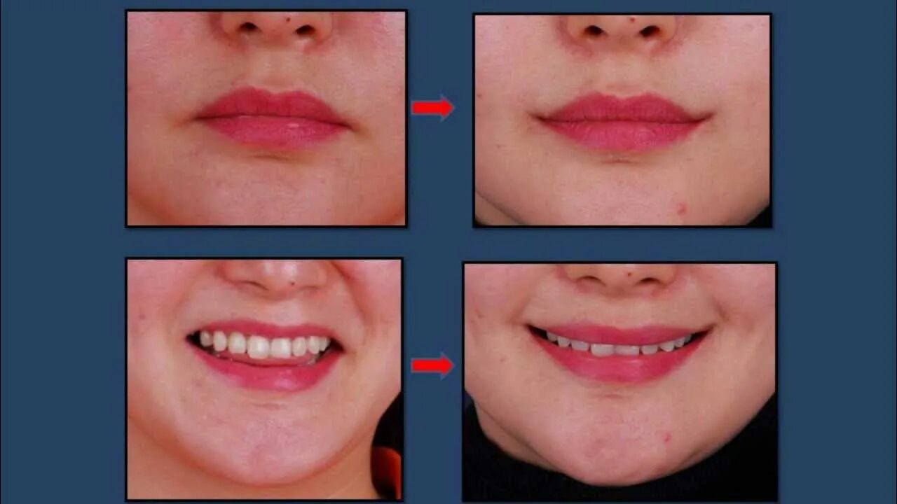 Подрезать уздечку верхней губы взрослому фото Eng.Ver. Korean Plastic Surgery: Mouth corner lift - Smile Lipt - YouTube