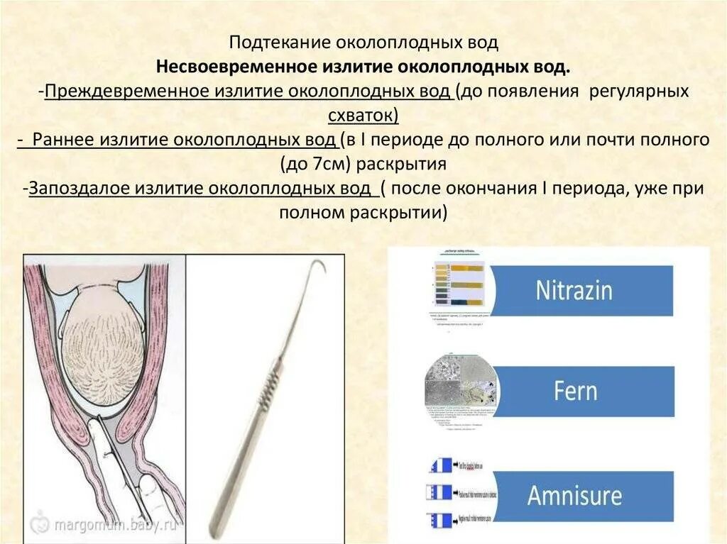 Подтекание вод как определить фото Признаки подтекания околоплодных вод