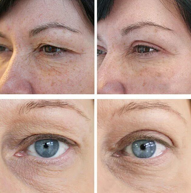 Подтяжка глаз до и после фото Blepharoplasty - Coolaser Clinic