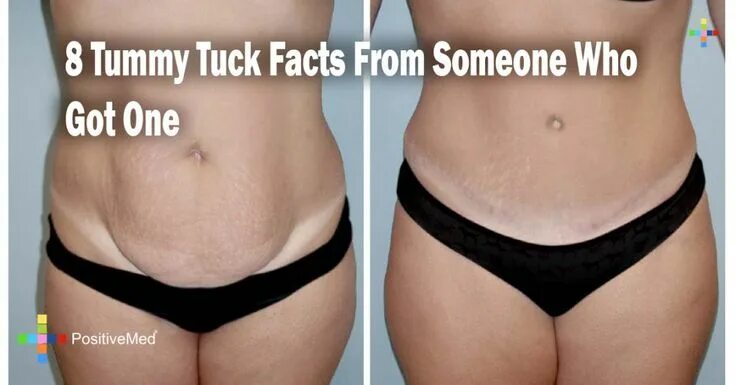 Подтяжка груди нитями фото до и после 8 Things You Should Know About A Tummy Tuck—From Someone Who Got One Tummy tucks