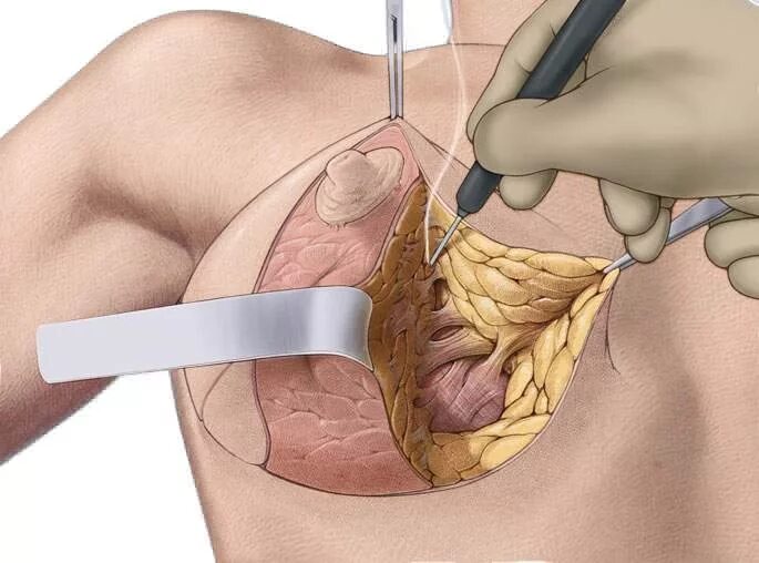 Подтяжка груди отзывы фото до и после Якорная подтяжка груди (грудных желез) Т-образная мастопексия в Москве