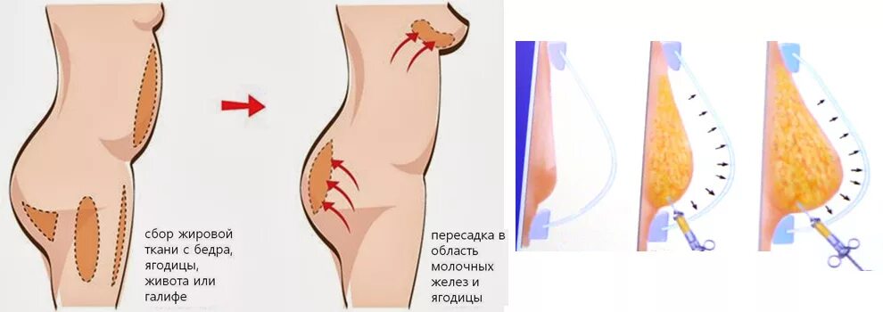 Подтяжка груди отзывы фото до и после Липофилинг молочных желез по доступной цены в Минске