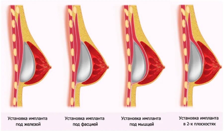 Подтяжка груди отзывы фото до и после Увеличение груди стоимость операции, цены в Москве - Дека Клиника