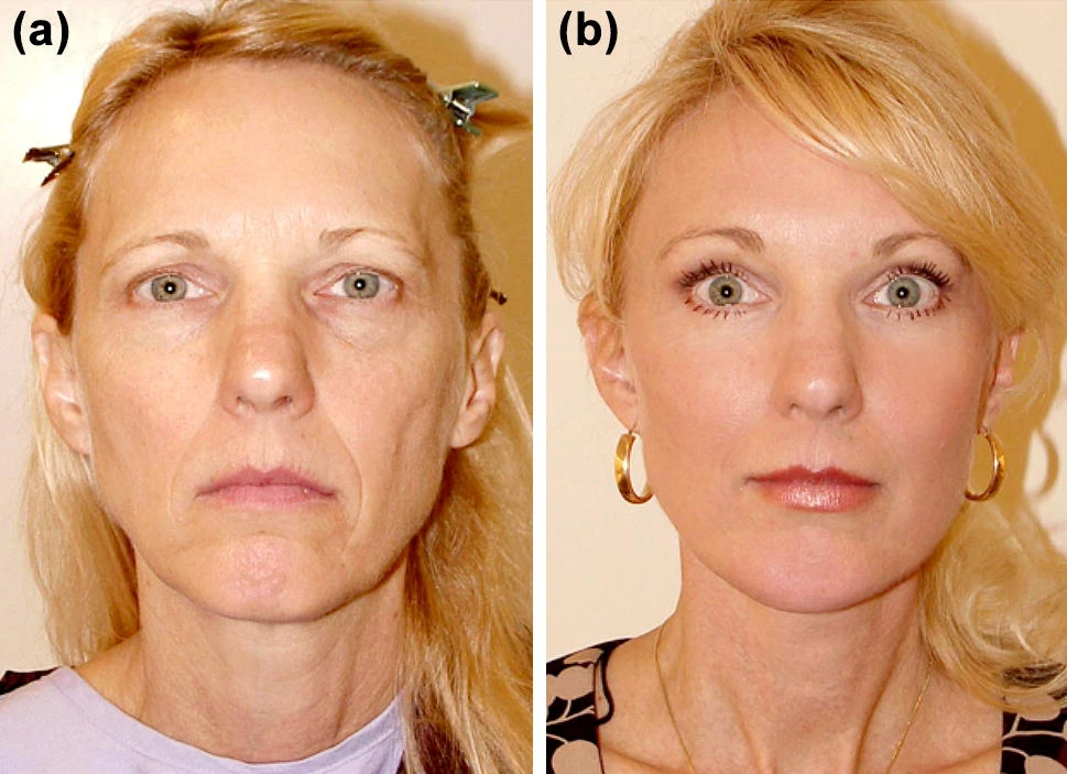 Подтяжка лица фото Facial Fat Grafting: Why, Where, How, and How Much - Aesthetic Plastic Surgery F