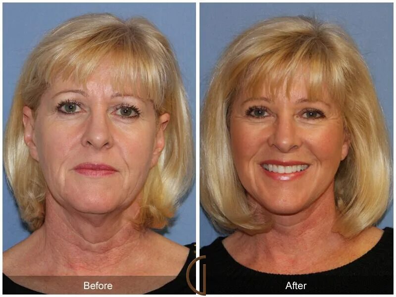 Подтяжка лица фото до и после женщины Neck Lift Newport Beach Platysmaplasty Dr. Kevin Sadati