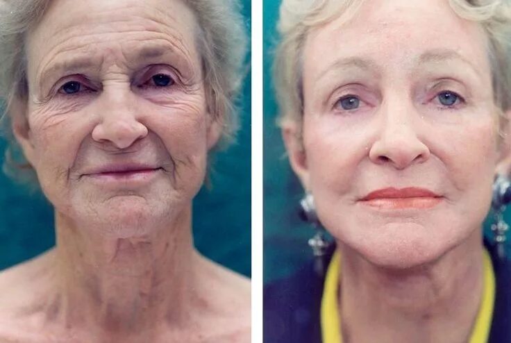 Подтяжка лица фото до и после женщины Pin on Attaining A Faultless Facelift Without Surgery Employing Facial Workouts