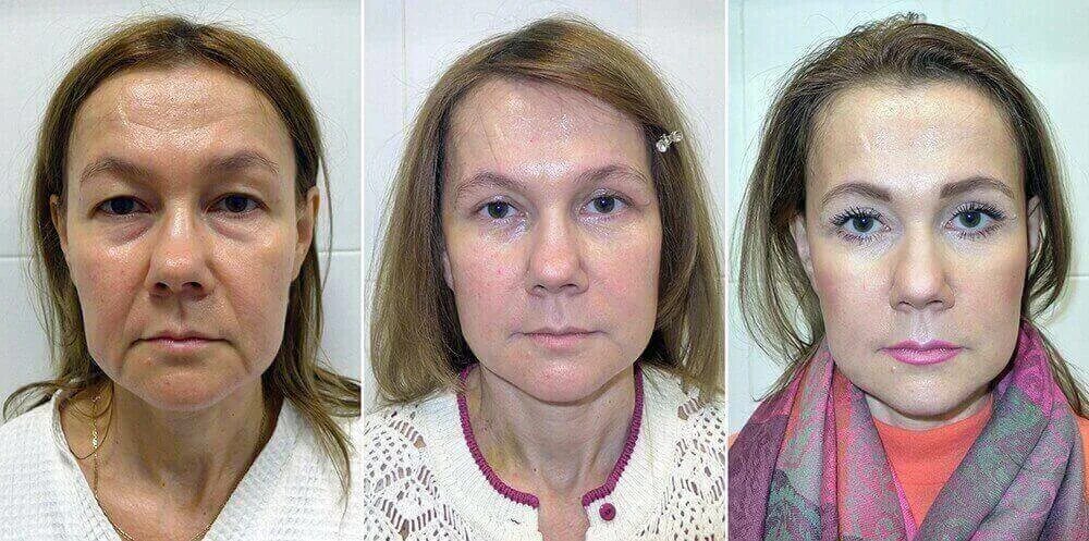 Подтяжка лица отзывы фото SMAS face lifting - Coolaser Clinic