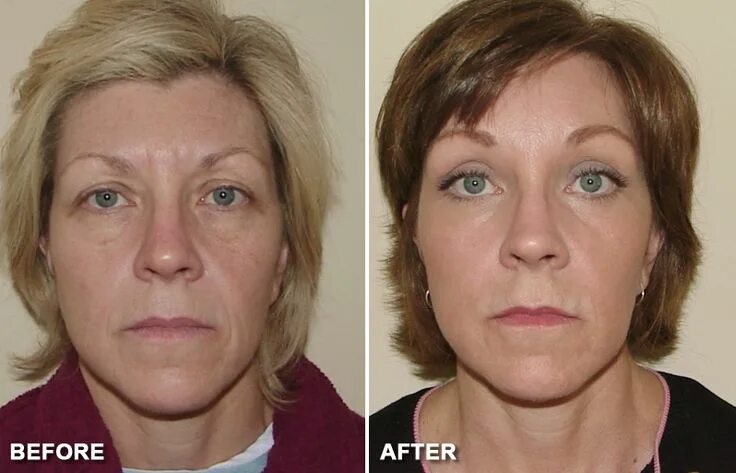 Подтяжка век лазером фото до и после Anderson Eyelid Surgery: Blepharoplasty Guide Beauty procedures, Eyelid surgery,