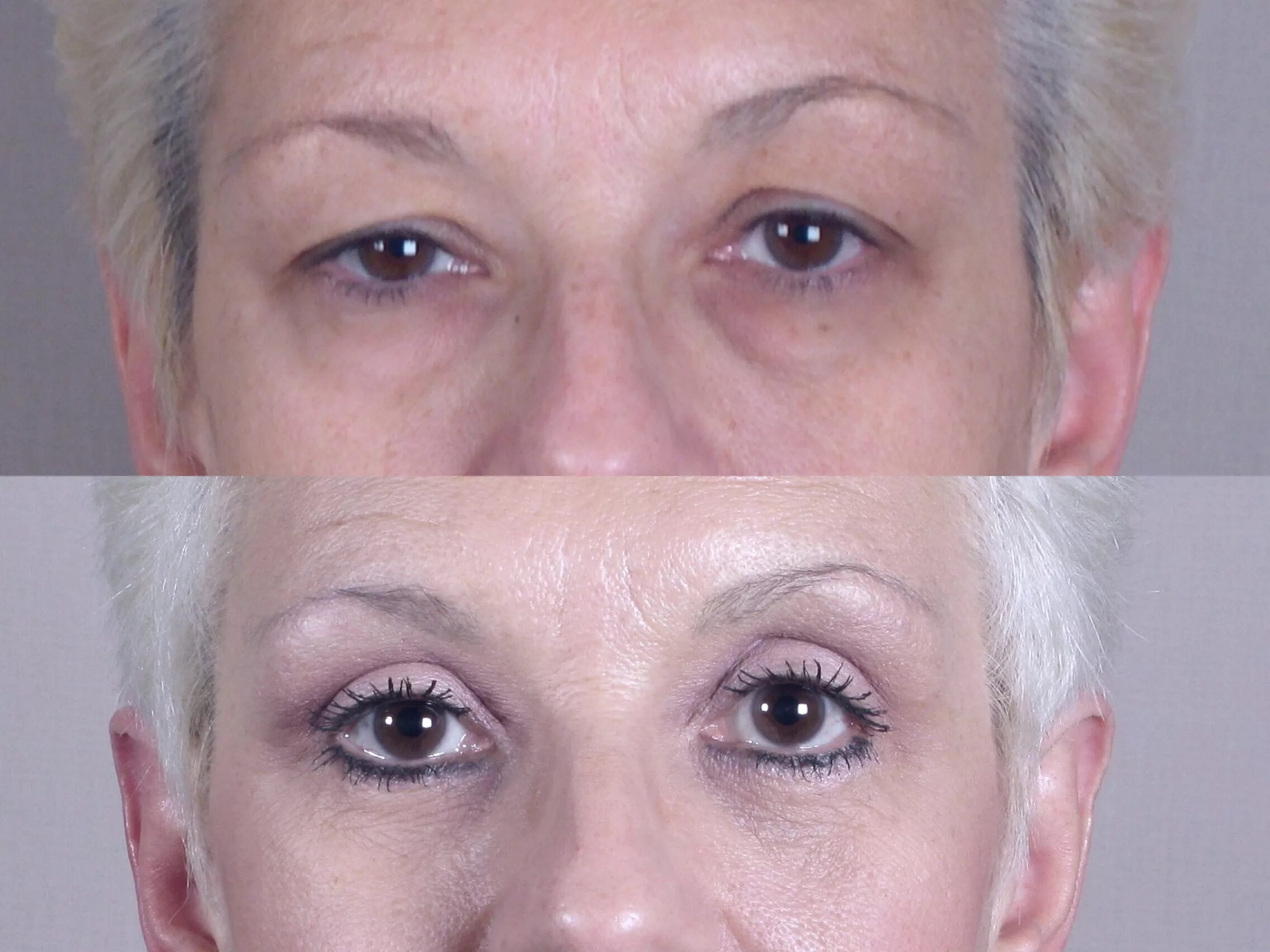 Подтяжка верхнего века фото eyelid surgery nj Cheaper Than Retail Price Buy Clothing, Accessories and lifest