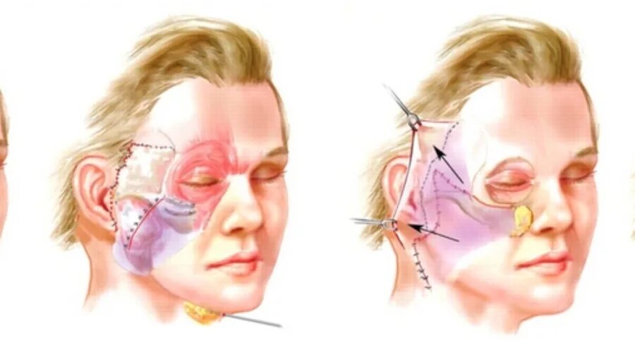 Подтяжка верхней трети лица фото Пластическая подтяжка нижней трети лица