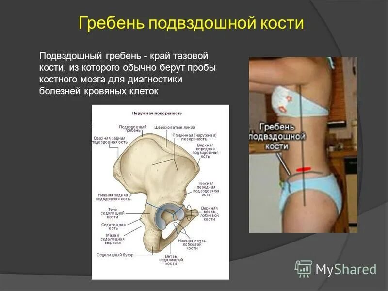 Подвздошная кость фото Подвздошная кость тазовой кости