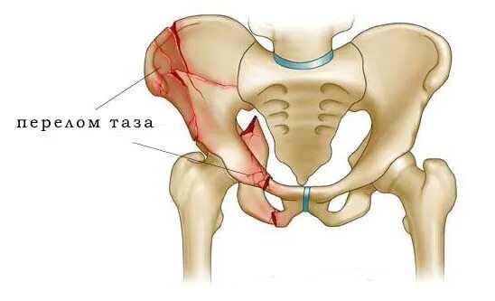 Подвздошная кость где фото Травмы нижних конечностей: виды и доврачебная помощь