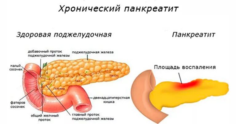 Поджелудочная железа симптомы фото Панкреатит: как питаться на разных стадиях болезни