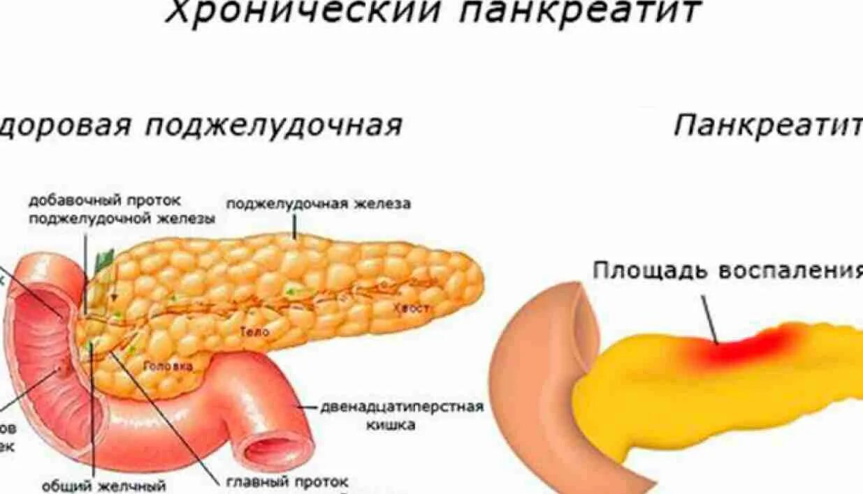 Поджелудочная железа симптомы и лечение фото Поджелудочная железа симптомы где