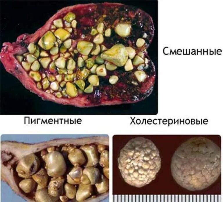 Поджелудочный камень фото Картинки НАЛИЧИЕ КАМНЯ В ЖЕЛЧНОМ ПУЗЫРЕ