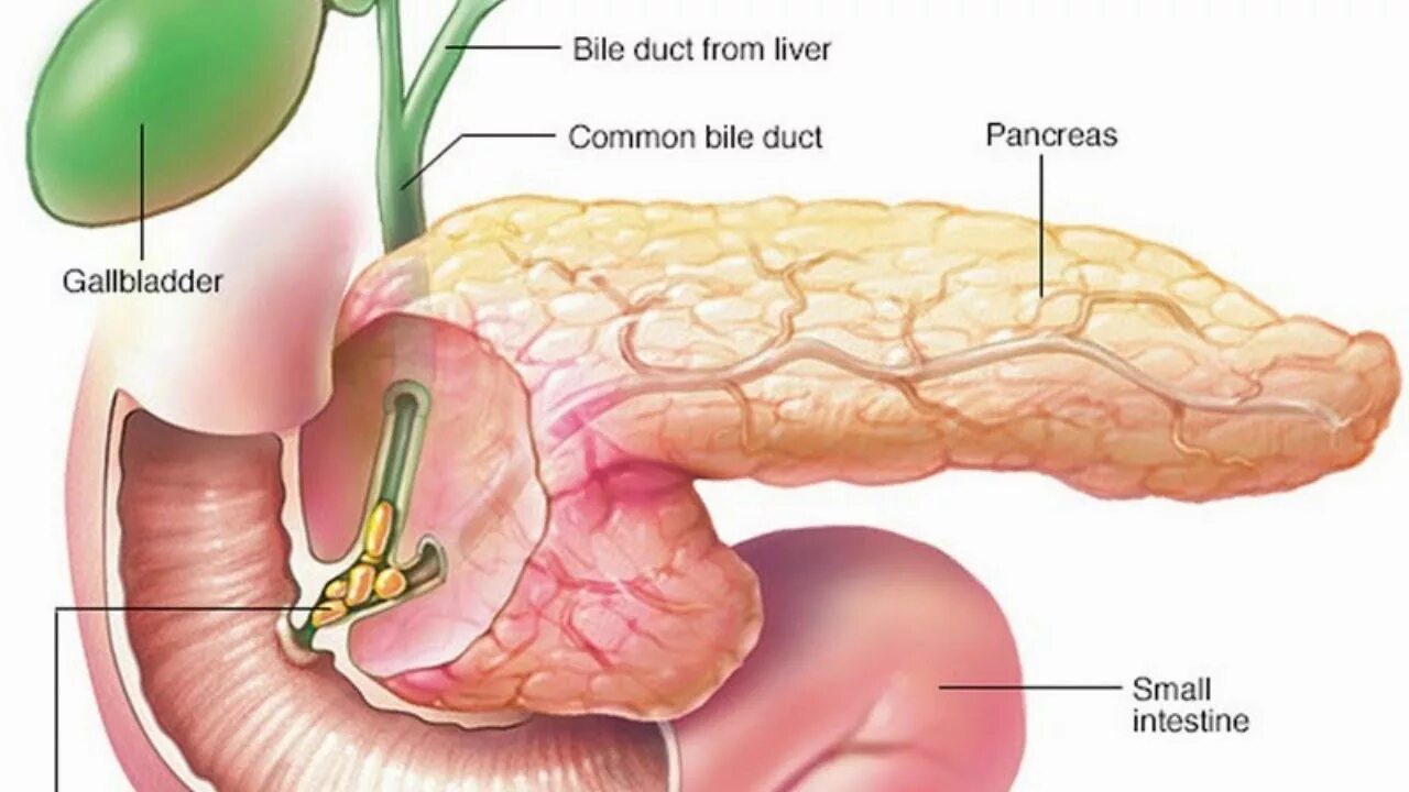 Поджелудочный камень фото 急 性 胆 囊 炎 胆 石 症 胆 结 石 发 作 疗 愈 音 乐 acute cholecystitis healing music - YouTube