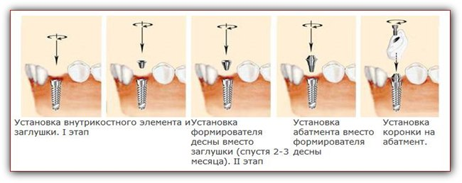 Поэтапная установка импланта зуба фото Установка зубного импланта. 3 процедура, конец пути уже рядом. Растём вместе с д