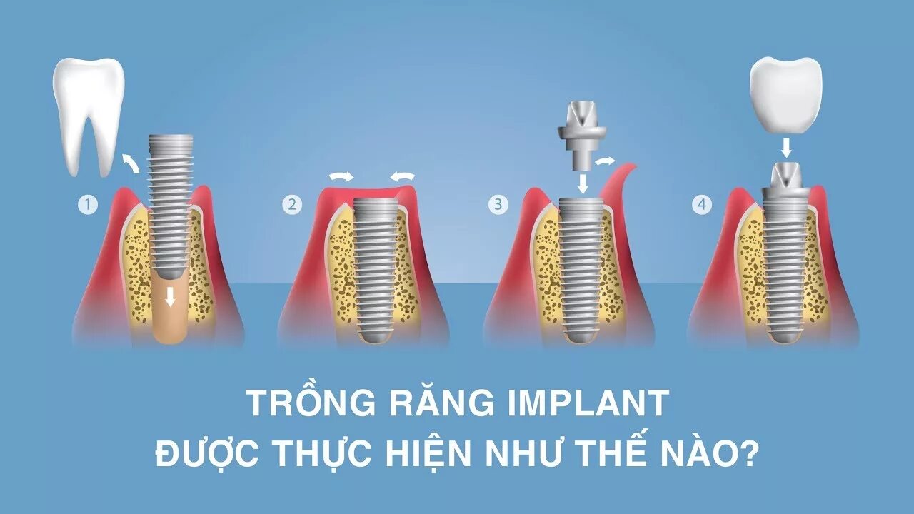 Поэтапная установка импланта зуба фото Trồng răng Implant Được Thực Hiện Như Thế Nào? - YouTube