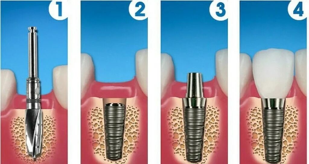 Поэтапная установка импланта зуба фото Импланты зубов - рейтинг производителей, зачем нужны, фото