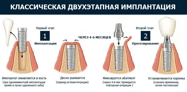 Поэтапная установка импланта зуба фото Кому подходит имплантация зубов. Её плюсы.