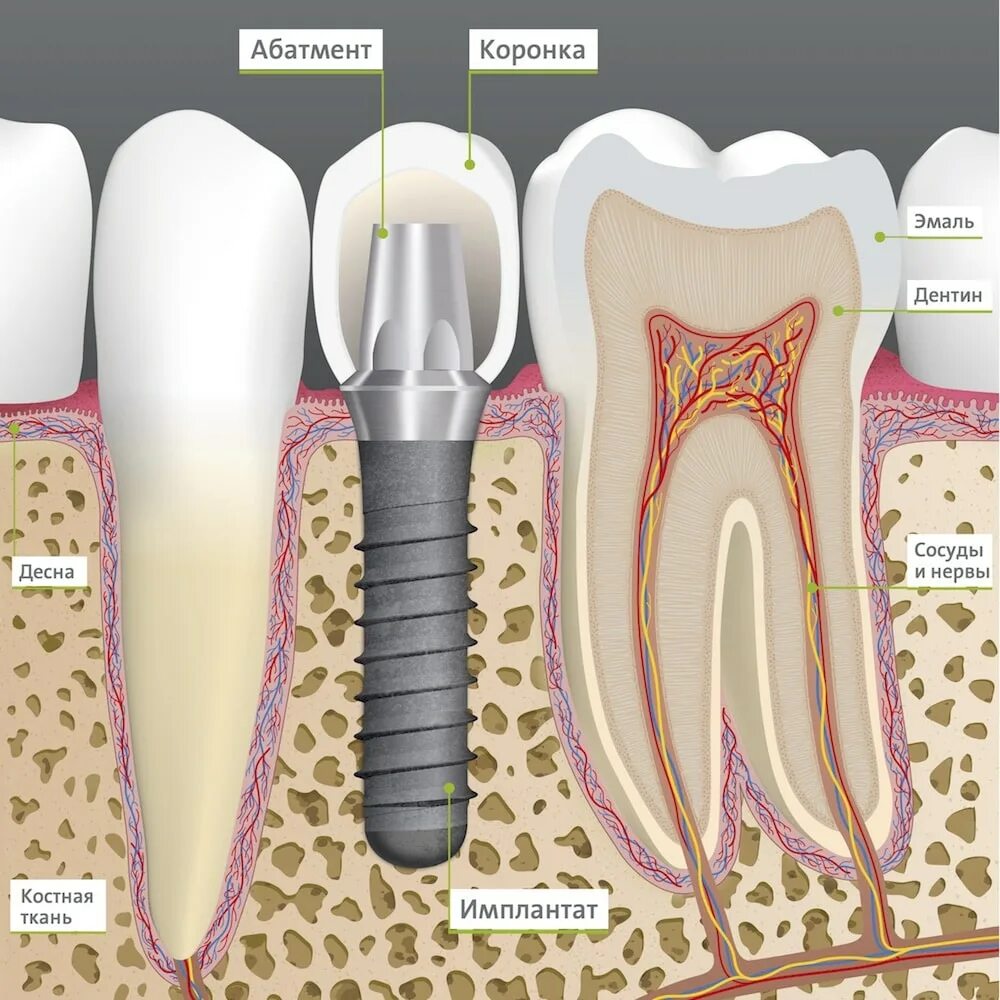 Поэтапная установка импланта зуба фото Металлокерамическая коронка на имплант - цена протезирования металлокерамикой зу