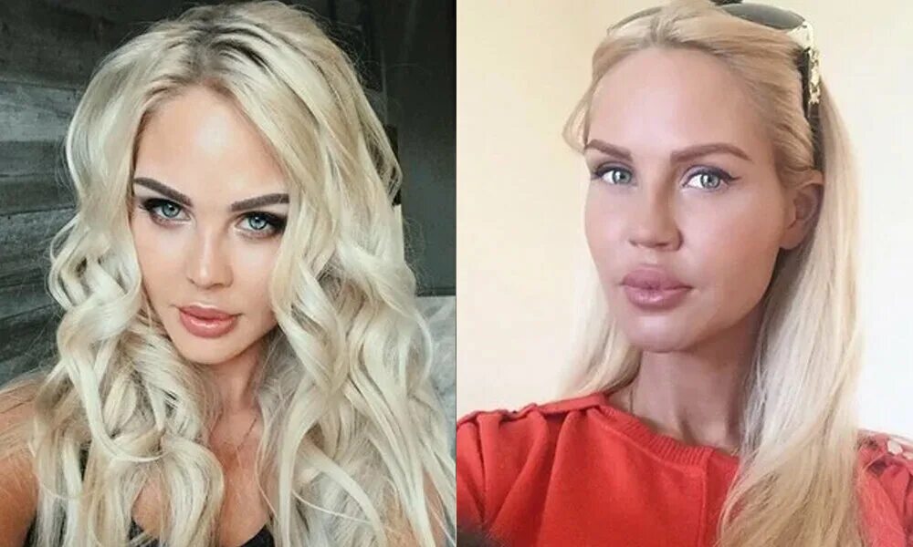 Погребняк до и после пластики фото Улыбаться опасно: 10 звезд, чьи пластические губы вызывают смех и ужас Хорошие ф