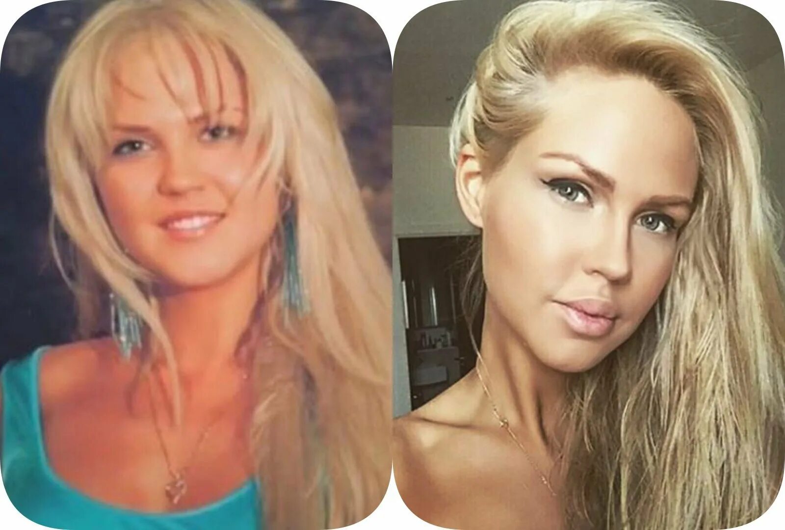 Погребняк до и после пластики фото Звезды, плотно подсевшие на иглу красоты