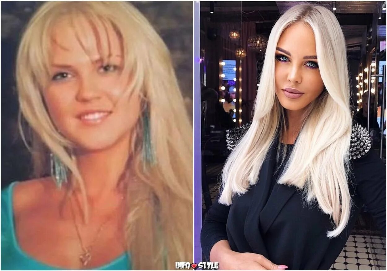 Погребняк до и после пластики фото Погребняк фото до и после: найдено 85 изображений