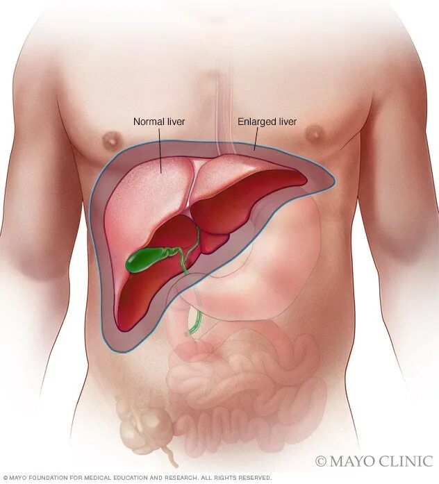 Показать фото где находится печень Enlarged liver - Symptoms & causes - Mayo Clinic