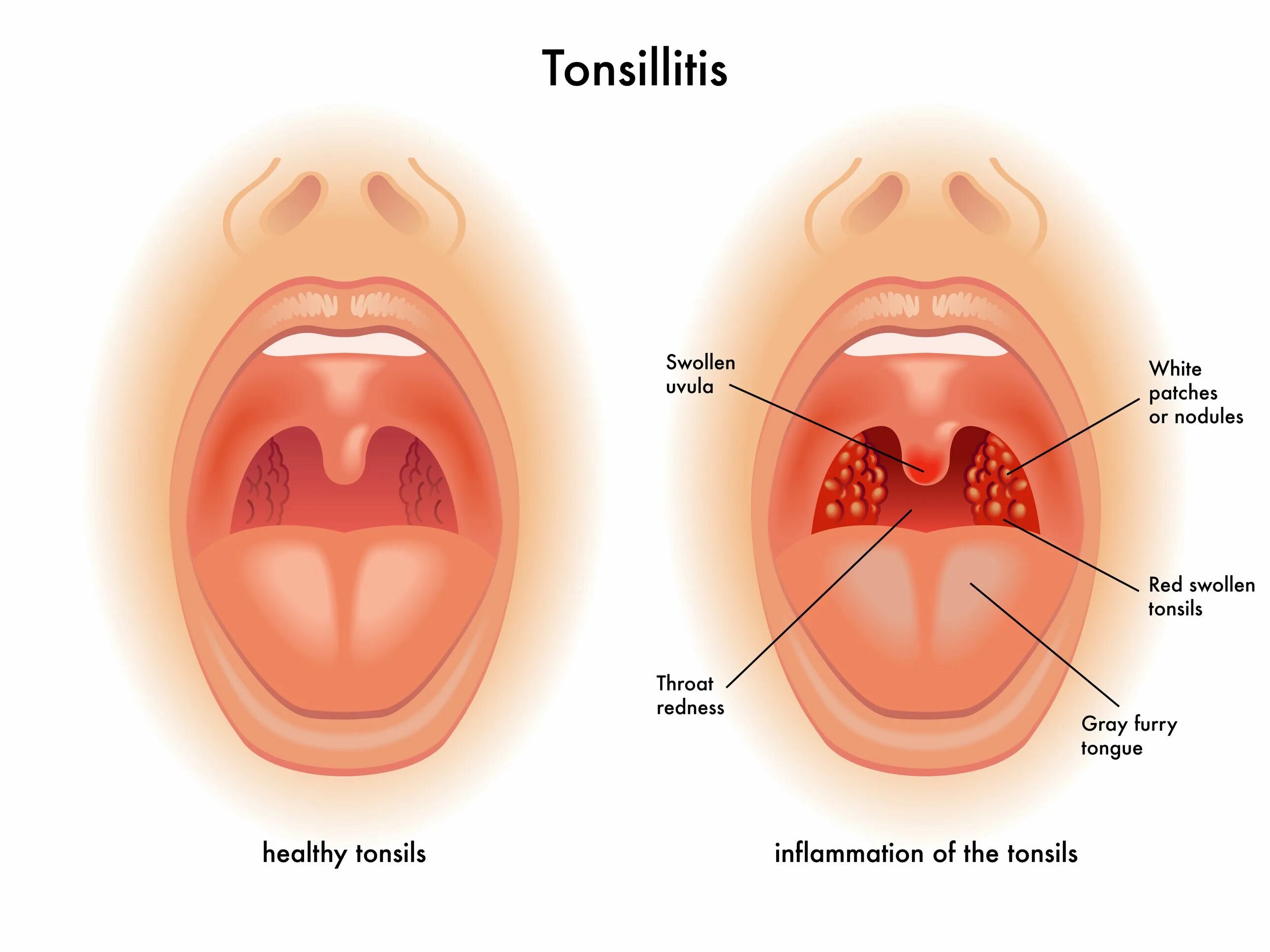 Показать фото горла Ask Dr Rajesh Shah, MD Homeopathic Doctor, Life Force Homeopathy Clinics, Mumbai