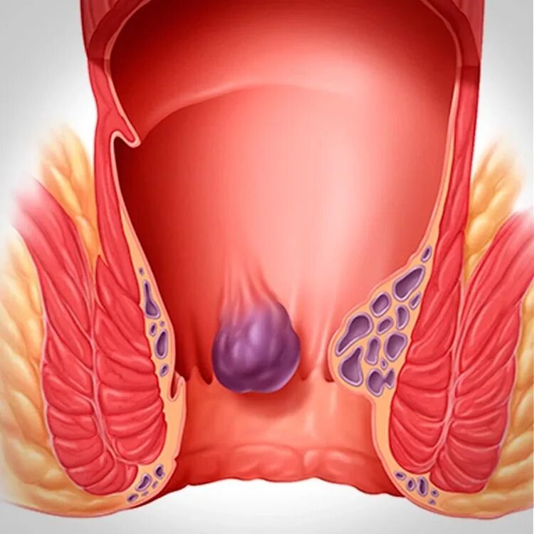 Показать фото как выглядит геморрой Лигирование геморроидальных узлов
